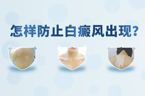如何預(yù)防白癜風(fēng)比較科學(xué)呢？