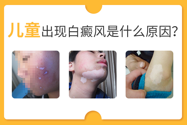 為什么小孩子這么容易得白癜風(fēng)呢？