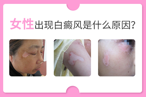 誘發(fā)女性長(zhǎng)白癜風(fēng)的原因有哪些呢？