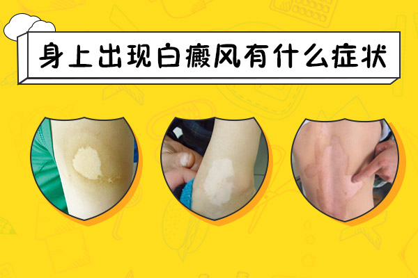 身上出現(xiàn)白癜風(fēng)有什么癥狀呢？