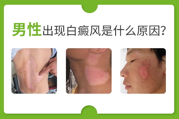 男性手上易長白癜風是怎么回事？