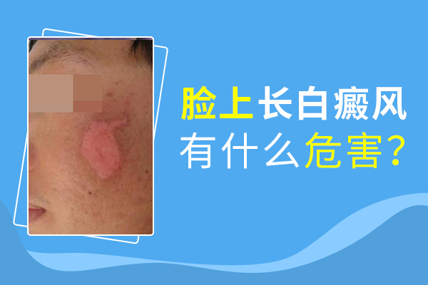 臉部白癜風會給患者帶來什么傷害呢？