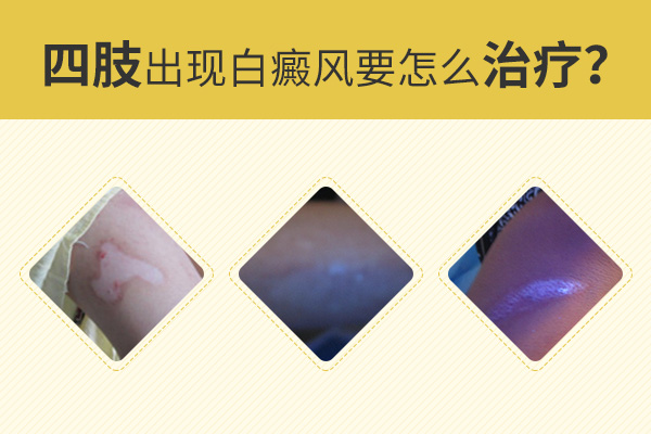 為什么手腳上的白癜風(fēng)會比較難治呢？