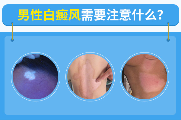 合肥男性確診得了白癜風(fēng)要怎么做才好呢？